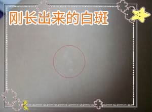 白癜风的原因是病情好转后反复