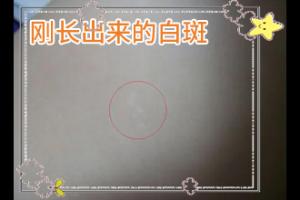 白癜风的原因是病情好转后反复