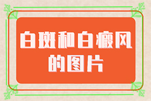 患者得了白癜风这些不良的习惯极可能成为诱因。