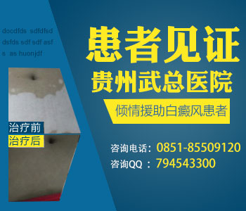 型白癜风有哪些表现症状