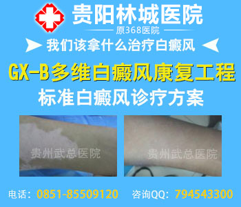 白癜风的遗传性怎么样呢
