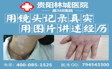 有哪些数据是白癜风危害的