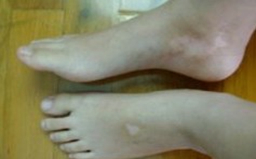 白癜风能不能恢复