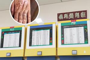 卡泊三醇能治疗白斑吗