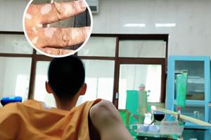 白癜风病因学说是什么检查