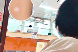 0.03%浓度他克莫司软膏