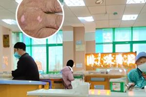 阿洛昔韦软膏副作用