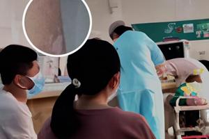 伍德灯下的隐性白斑图片