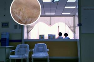 他克莫司是治什么的