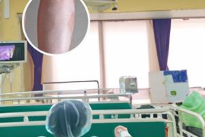 他克莫司与西罗莫司联合用药