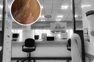 伍德灯可以确诊哪些皮肤病