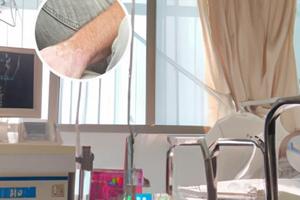 他克莫司软膏主要治疗白斑和汗斑吗