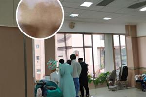 伍德灯淡白色边界模糊