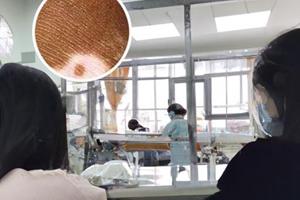 伍德灯治疗白斑治疗好吗