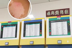 先抹卤米松还是他克莫司