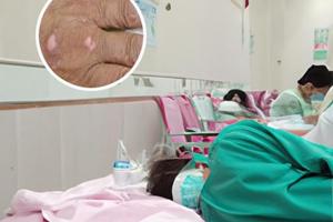 他克莫司使白斑会变黑吗