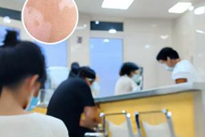 白癜风病人能吃燕窝