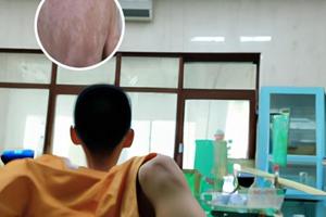 308准分子治疗