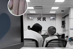 白癜风怎么判断是不是遗传