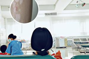 白癜风与银屑病是一回事吗