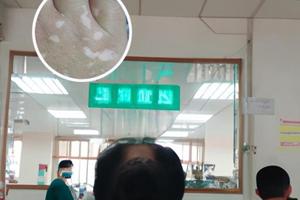 皮肤镜的检查适应