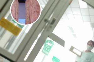 九个月宝宝头上有块色素减退斑怎么回事