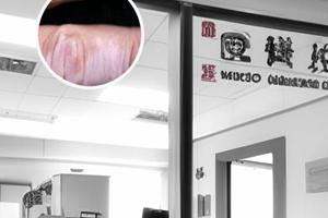 白癜风光疗后白斑更白了