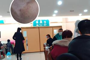 311白斑激光治疗仪的作用