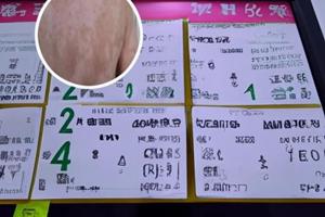 308对痣有影响吗