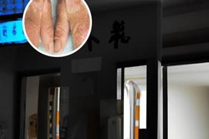 色素脱失症治疗多少钱一次