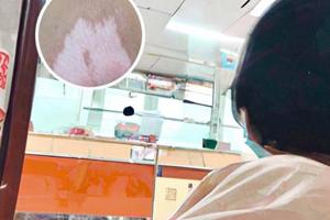 色素减退斑的症状图片是什么