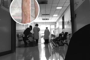 308激光照射后起水泡正常吗