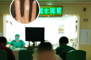 小孩脸上出现了色素减退斑怎么回事