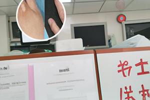 308激光治疗手指有效吗视频