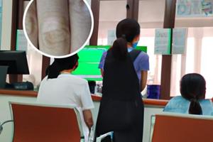 艾洛松软膏面部使用