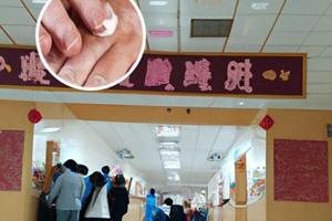 他克莫司软膏可以治疗