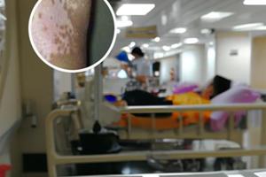 孩子得了色素脱失症怎么治疗好点