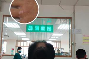 嘴唇白癜风能用308治好吗