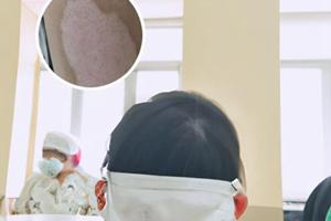 卤米松乳膏白癜风原理