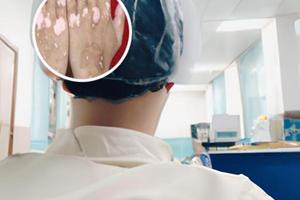 白斑光疗后变红了