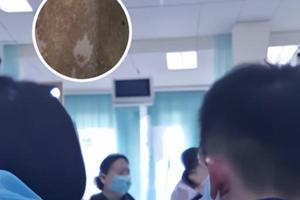 伍德灯能照出真菌感染吗