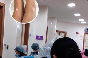 白癜风光疗一天做两次有用吗