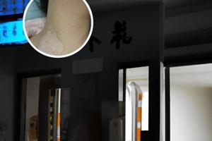 他克莫司能用于白癜风吗