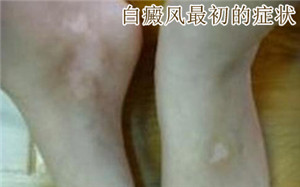 白癜风的治疗与什么因素有关系