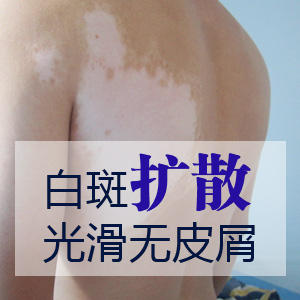 怎样治疗白癜风才好