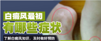 白癜风发展期怎么治疗