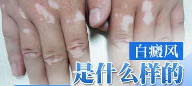 手上的白斑怎么治