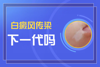 中老年白癜风的医治办法有哪些