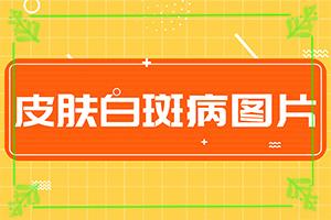 白癜风民间治疗验方药方是什么