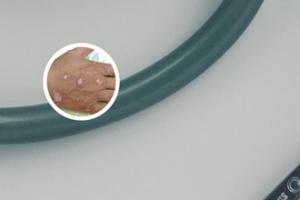 丙酸氯倍他索乳膏是治疗白癫疯吗